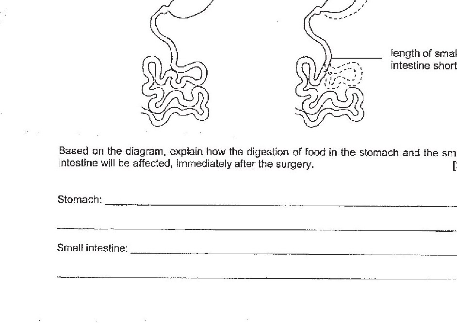 Two side-by-side diagrams showing the digestive system before and after surgery. The 'before surgery' diagram shows a normal stomach and coiled small intestine. The 'after surgery' diagram shows a reduced stomach size (indicated by dotted lines showing the reduction) and a shortened small intestine (indicated by dotted lines showing the portion removed). Labels point to 'size of stomach reduced' and 'length of small intestine shortened'.