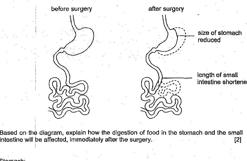 Two side-by-side diagrams showing the digestive system before and after surgery. The 'before surgery' diagram shows a normal stomach and coiled small intestine. The 'after surgery' diagram shows a reduced stomach size (indicated by dotted lines) and shortened small intestine (indicated by dotted lines showing removed portion). Labels point to 'size of stomach reduced' and 'length of small intestine shortened'.
